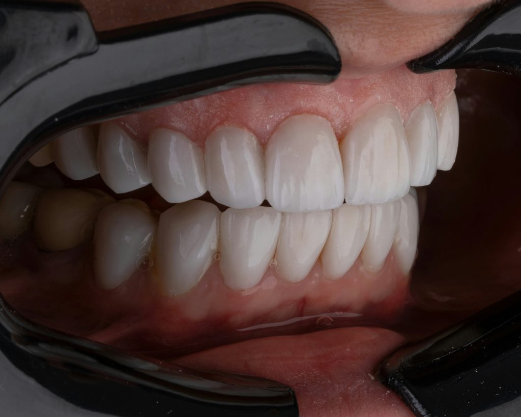 Veneers process